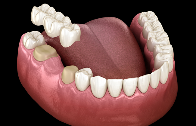 Illustration of a dental bridge replacing a missing tooth