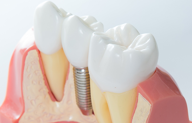 Model of a dental implant between two natural teeth