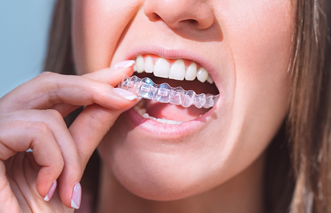 Person placing a clear aligner over their teeth