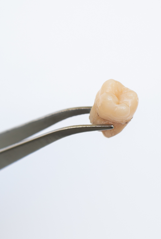 Tweezers holding an extracted tooth